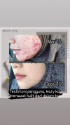 MASALAH KULIT JERAWAT/JERAGAT/ KULIT KUSAM
