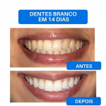 Promoção Clareamento Dental