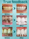 Quick And Deep Cleaning Of Teeth To Remove Tobacco Coffee Stains