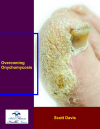 I treated nail fungus the same way I caught it… I reversed the steps and absolutely loved the results!