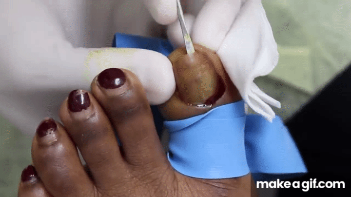 fungal nail infections