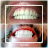 Beneficios GLISTER