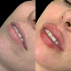 Preenchimento Labial