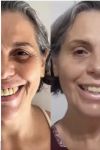 Tratamento com Exossomos