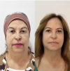 TRATAMENTO COM PDRN DNA DO SALMÂO